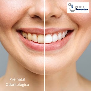 Clareamento Dental – Centro RJ