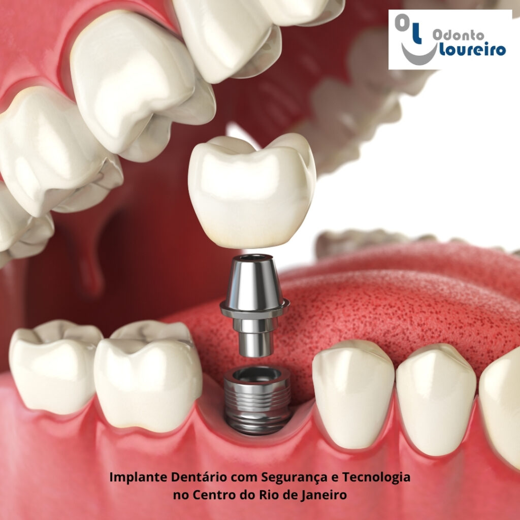 Implante Dentário no Centro do Rio de Janeiro: recupere seu sorriso com segurança e tecnologia