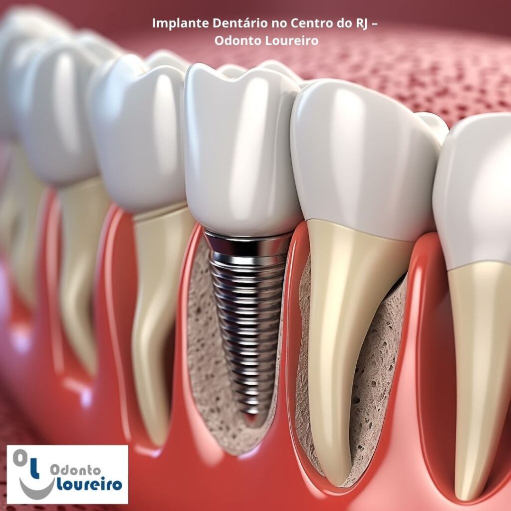 Implantes Dentários